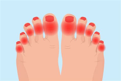 Arthritis In Toes Symptoms Causes Diagnosis And Treatment