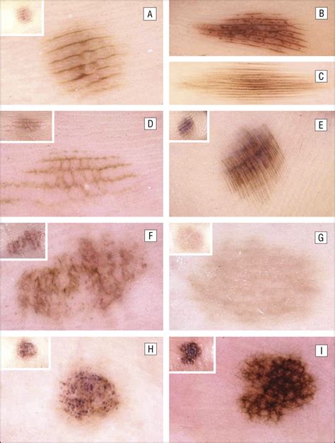 Dermoscopic Patterns Of Acral Melanocytic Nevi And Melanomas In A White