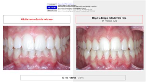 Malocclusione Di Classe 2 1 Dentista