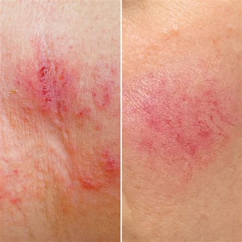 Eczema Vs Rosacea Whats The Difference Slmd Skincare By Sandra