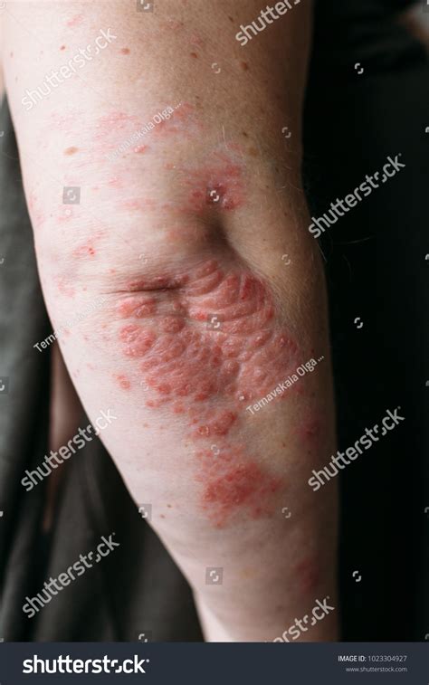 Psoriasis On Elbow Closeup Photo Dry Stock Photo Edit Now 1023304927