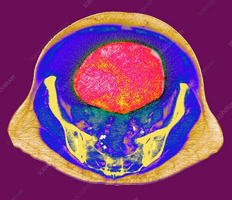 Ovarian Cancer Ct Scan Stock Image M8500542 Science Photo Library