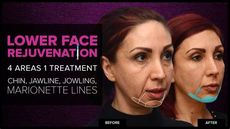Lower Face Rejuvenation Chin Jawline And Jowls With Dermal Fillers At