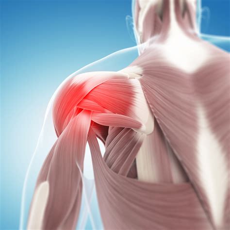 Rotator Cuff Muscles Archives Samarpan Physiotherapy Clinic Ahmedabad