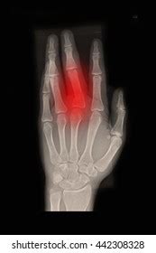 Closed Fracture Middle Finger Left Hand Stock Photo Shutterstock