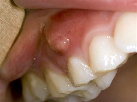 What To Know About Gum Boils Mckee Dental Associates