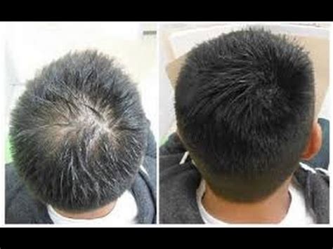 The drug blocks the enzymes found in hair. Hair Regrowth for Men Naturally With ArganRain Products ...