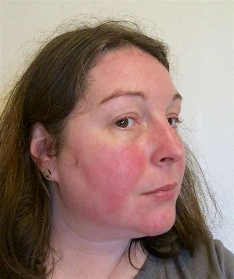 Lupus Can Cause A Red Butterfly Shaped Rash Across The Nose And Cheeks