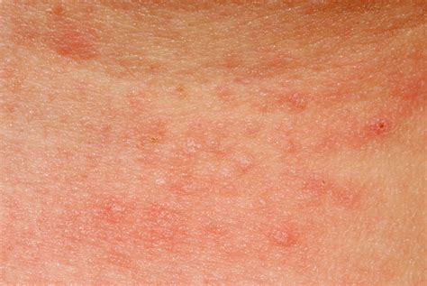 Allergy And Skin What To Do The Types And Causes Twinkle Thomas