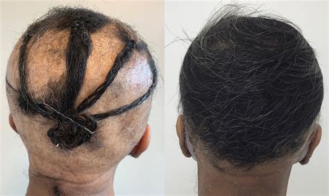 Hair Loss Specialist Columbia Md Dr Ife Rodney Eternal Dermatology