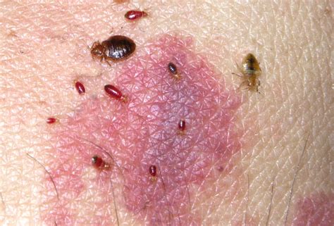 Gallery Bed Bugs Sloutions