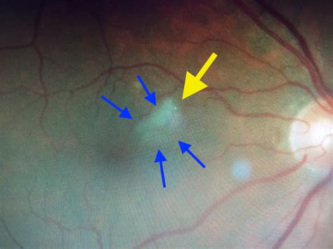 What Is A Branch Retinal Artery Occlusion Brao Retina Specialist