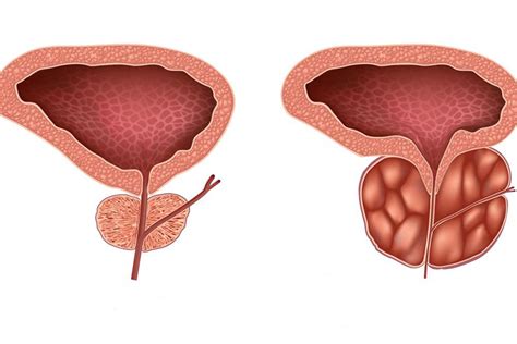 Prostatitis And What You Need To Know Urology Specialist