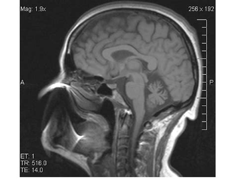 T1 Weighted Sagittal Brain Mri Showing Cerebellar Atrophy In Patient
