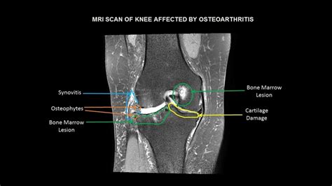 Osteoarthritis Knee Mri