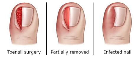 In a patient who suffers from this condition—also known as onychocryptosis—one or both corners of the nail can curl downward and dig into the skin. Ingrown Toenail Problems? - Almawi Limited The Holistic Clinic