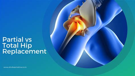 Partial Vs Total Hip Replacement By Dr Vikas Mehra Issuu