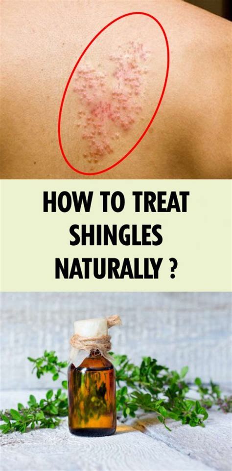 How To Treat Shingles Naturally Natural Rash Remedies Shingling