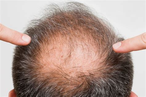 Causes Of Hair Loss In Men Andro Genetic