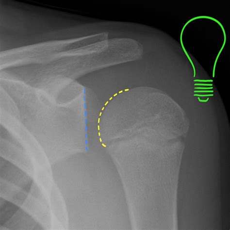 An X Ray Shows A Light Bulb In The Middle Of A Shoulder With A Blue Arrow Pointing Towards It