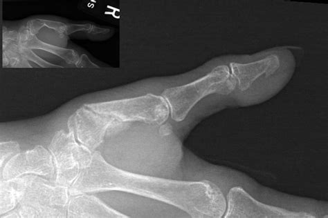 Thumb Metacarpal Fracture Hand Surgery Source