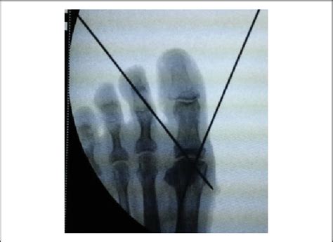 Fluoroscopy Of First Mtpj Arthrodesis Mtpj Metatarsophalangeal Joint