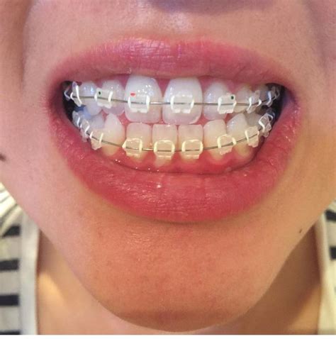 Playful And Pretty Braces Color Ideas For Everyone Healthy Lifestyle Health Aesthetic Em