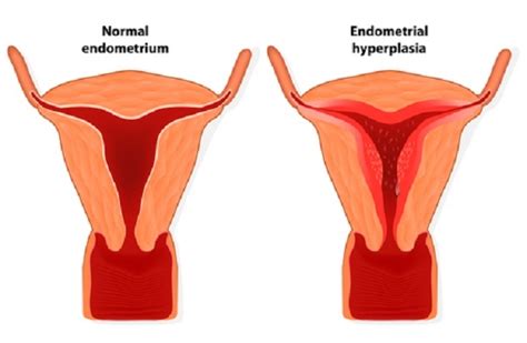 Diagnosis Hiperplasia Endometrium Alomedika Hot Sex Picture
