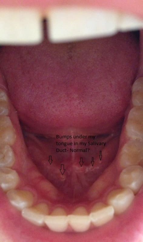 5 Small Bumps Under My Tongue Along My Salivary Duct What Could It Be
