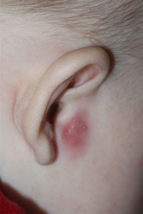 Swollen Lymph Node In Front Of Ear