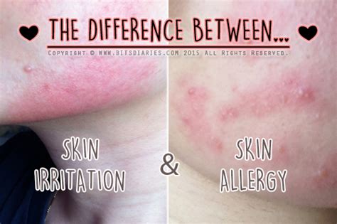 Do hives and rash look similar? Difference Between Skin Irritation and Allergy Caused By Products + TIPS