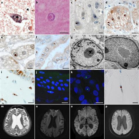 Histopathological Features And Brain Mri Findings From Patients With