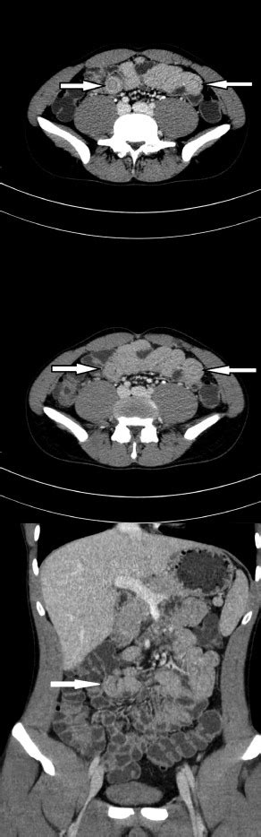 Where Does Capsule Endoscopy Fit In The Diagnostic Algorithm Of Small Bowel Intussusception