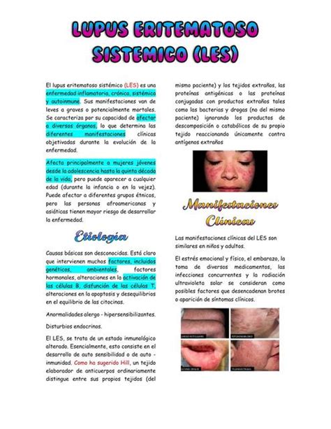 El Lupus Eritematoso Sistémico Y La Artritis Reumatoide Udocz