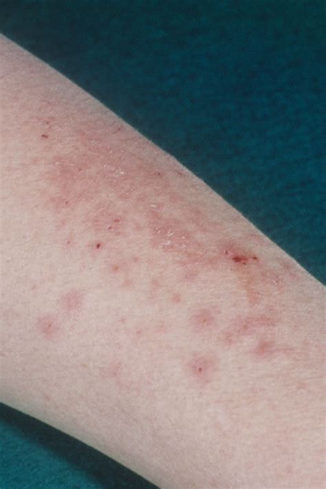 Childhood Rashes Skin Conditions And Infections Photos Artofit