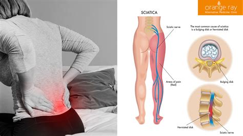 6 Most Common Causes Of Sciatic Nerve Pain Nyk Daily