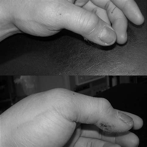 Anteroposterior And Lateral X Rays Of The Left Thumb Showing Volar