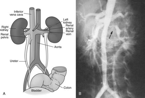 Abdominal Aortography And Genitourinary System Procedures Radiology Key