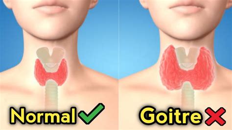 Goitre Disease Treatment Causes Treatment And Symptoms Of Goitre