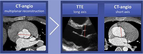 A Comparison Of Aortic Root Measurements By Echocardiography And