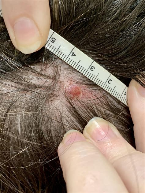 How To Know If You Have Skin Cancer On Scalp Is It Skin Cancer Cbs News However Did You