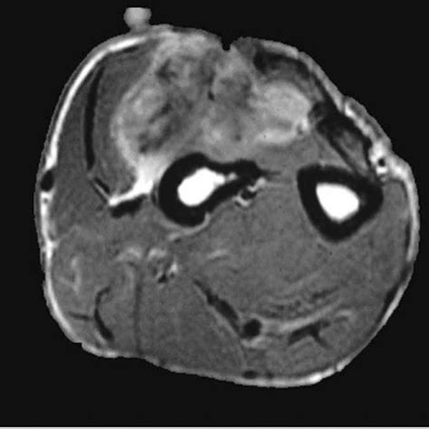 Axial T1 Post Gadolinium Enhancement Showing Areas Of Increased Signal