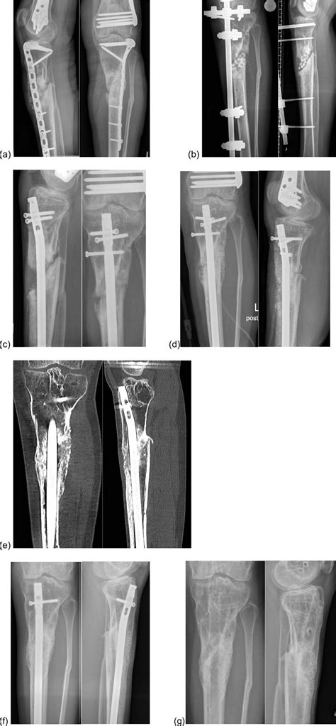 Bioactive Glass In Combination With Autologous Bone Graft In A Patient Download Scientific