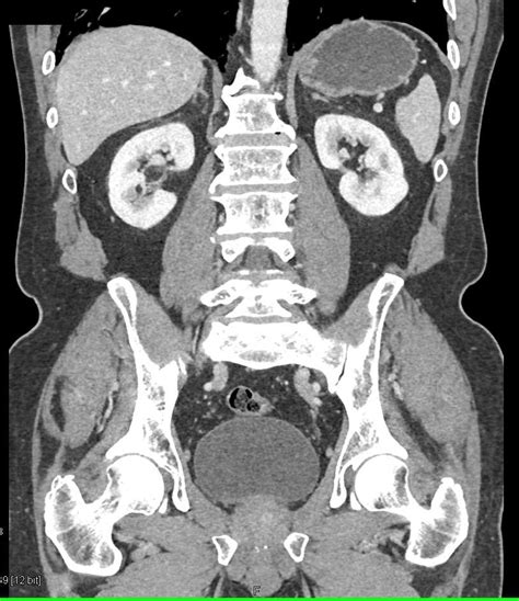 Acute Pyelonephritis Left Kidney Kidney Case Studies Ctisus Ct Scanning