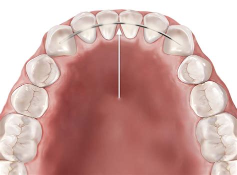 Orthodontic Retainers Skopek Orthodontics North Barrington Il