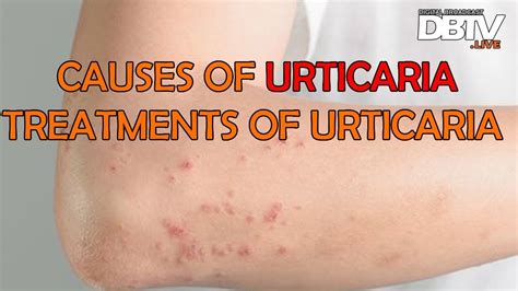 What Causes Urticaria Treatment Of Urticaria Types Of Urticaria