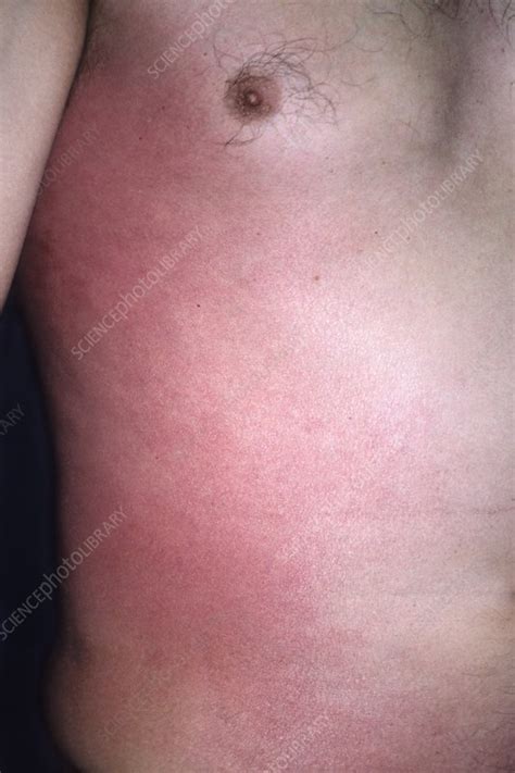 Allergic Rash Stock Image C0187549 Science Photo Library