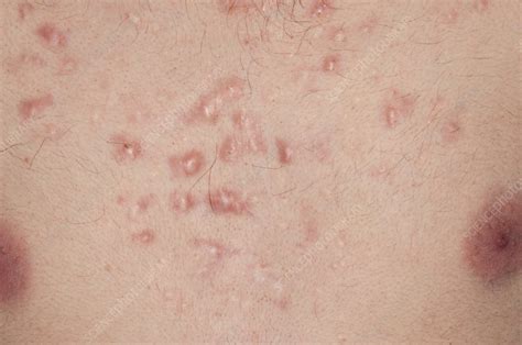 Keloid Scarring From Acne Stock Image C0117380 Science Photo Library