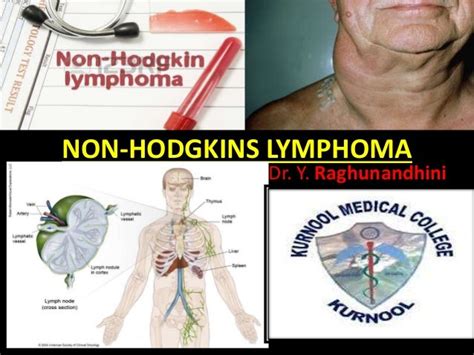Non Hodgkins Lymphoma Nandhu
