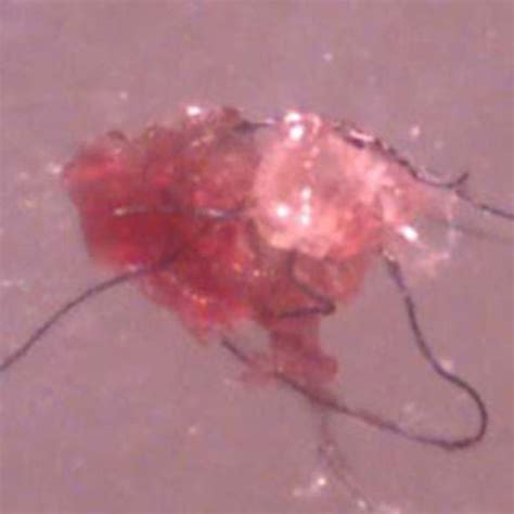 What Is Morgellons Disease Is It A Physical Or Psychological Condition Scientific American